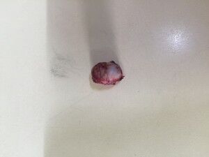 大腿骨頭2‐仁木アンズ