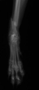 術前-DVトリミング後