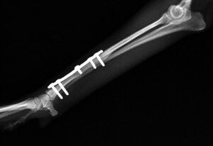 術後3ヶ月-Lトリミング後