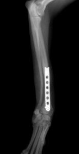 術後3ヶ月脱ピン後-DVトリミング後