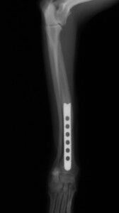 術後4ヶ月-DVトリミング後