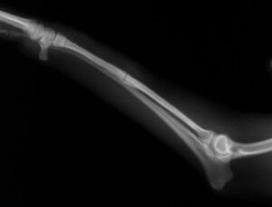 術後4ヶ月脱ピン後-Lトリミング後